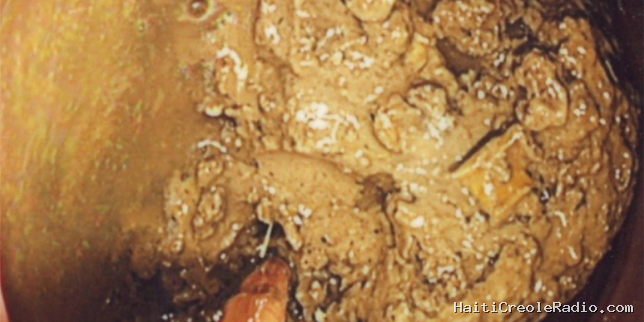 Constipation chronique : quand le Coca-Cola aide à dissoudre un fécalome géant