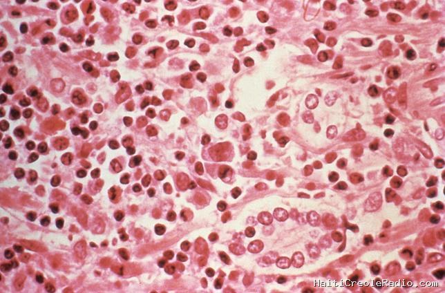 Qu’est-ce que l’infection à hantavirus ?