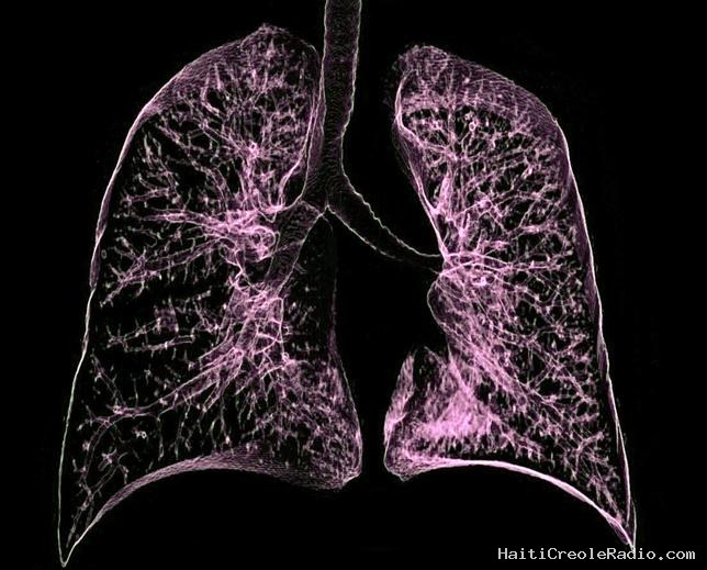 Une mutation génétique pourrait favoriser le cancer du poumon chez les non-fumeurs
